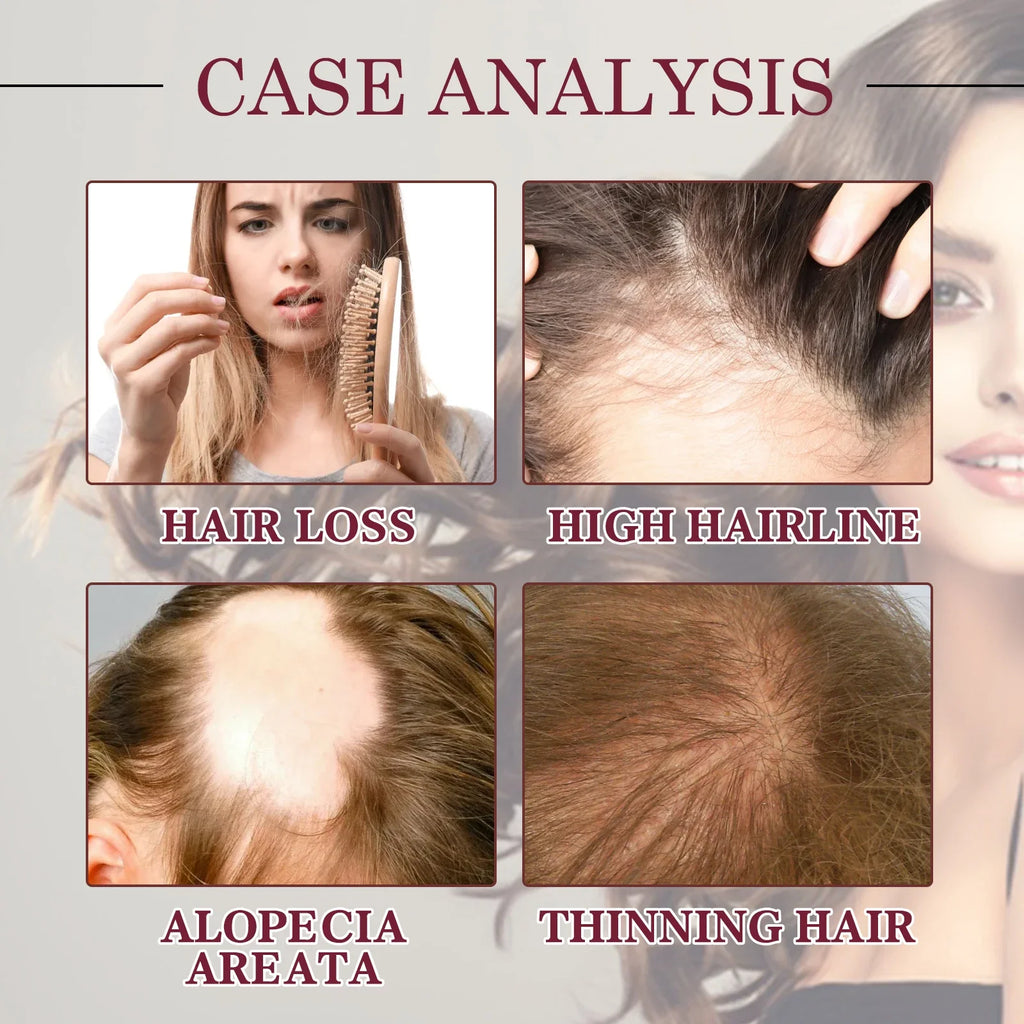 Spray para el cuidado del aceite esencial para el crecimiento del cabello, cebolla roja, previene la caída del cabello, nutre las raíces, mejora la textura del cabello, productos para el cuidado