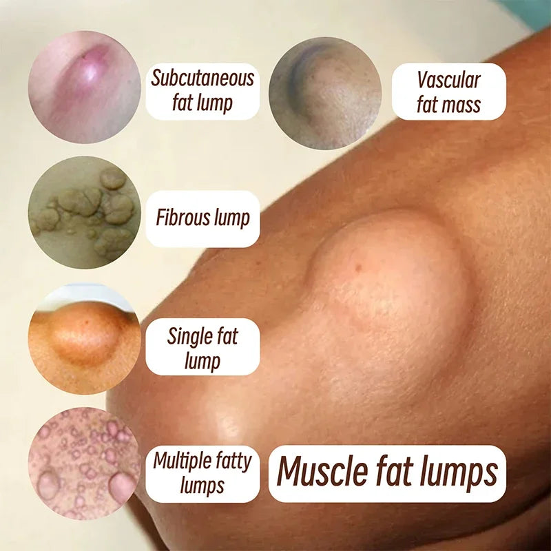 Crema Calmante Corporal | Eliminador Subcutáneo De Celulitis | Tratamiento Grasa Indoloro